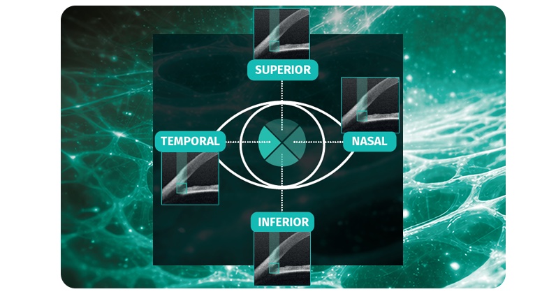 ASTRAL – puntería sobre la malla trabecular en los cuatro planos