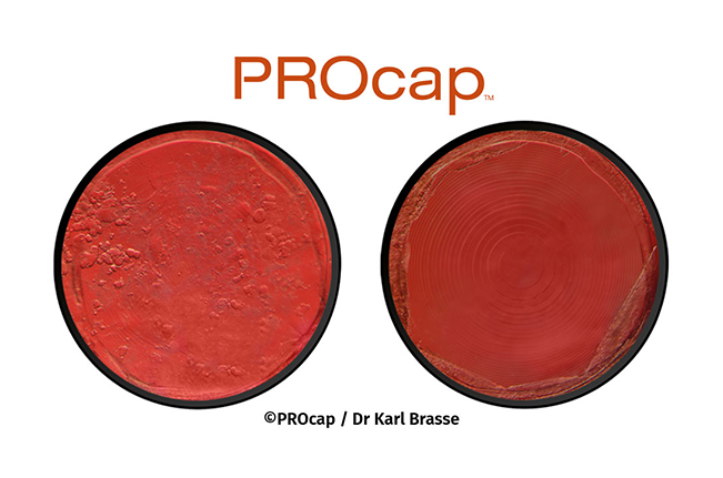 PROcap – comparación de capsulotomía posterior con láser YAG